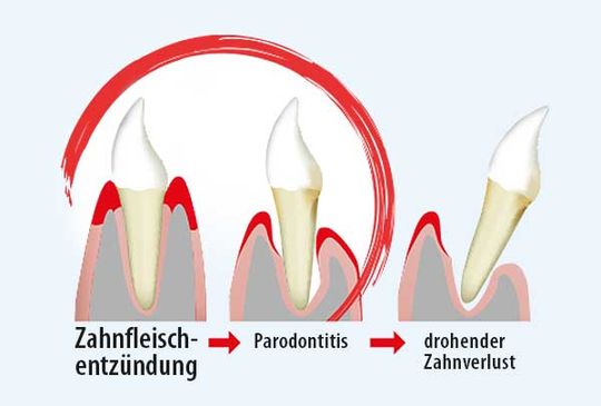 Itis-Protect® reduziert Entzündungen und beugt dadurch Parodontitis-bedingtem Zahnverlust vor Itis-Protect® reduziert Entzündungen und beugt dadurch Parodontitis-bedingtem Zahnverlust vor